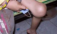 Cần phát hiện sớm bệnh Hemophilia